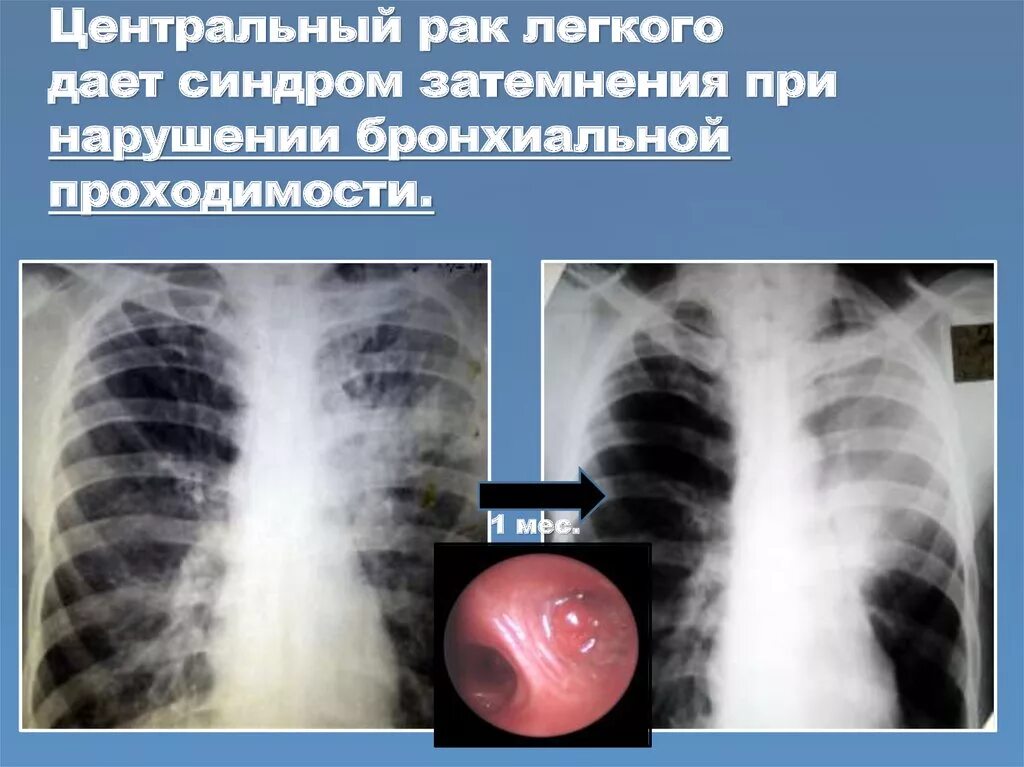 Стадии рака бронха. Уентральныйрак легкого. Центральная опухоль легкого.