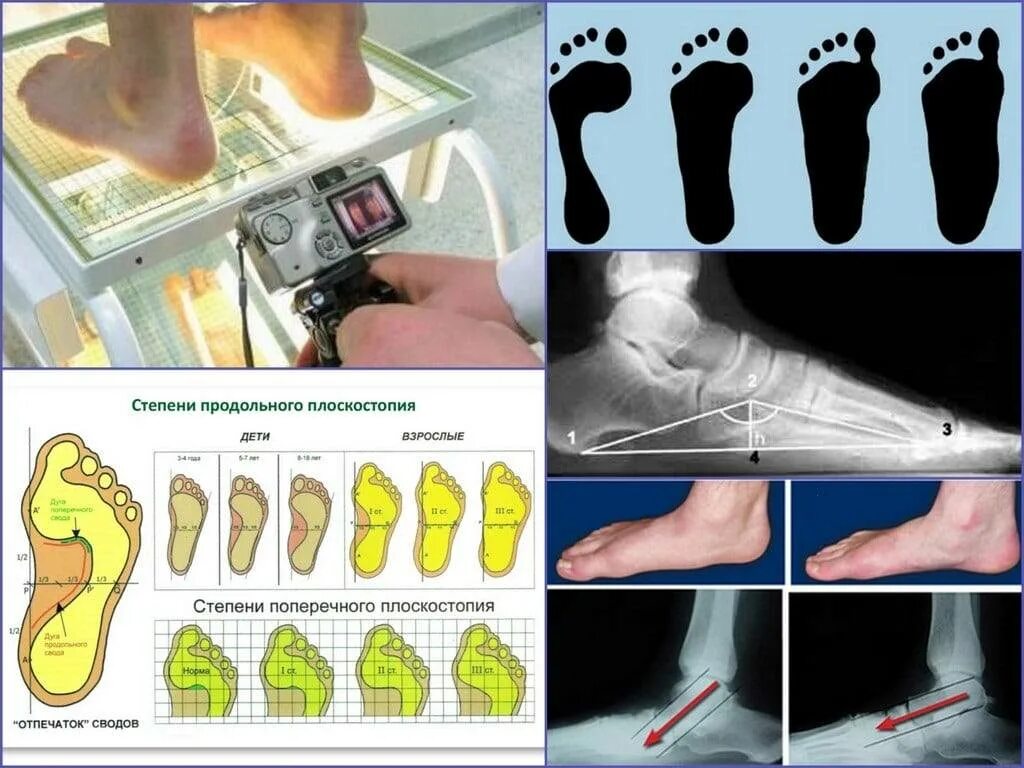 Продольно-поперечное плоскостопие 3 степени. Поперечное плоскостопие 2 степени. Поперечно продольное плоскостопие 3 степени. Плоскостопие 1, 2, 3 степени.
