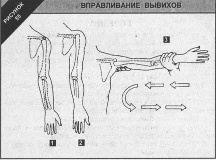 Вывихи верхней конечности