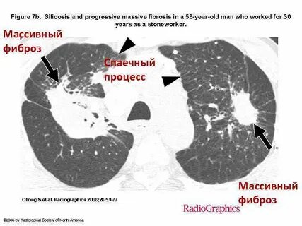 Пневмокониоз