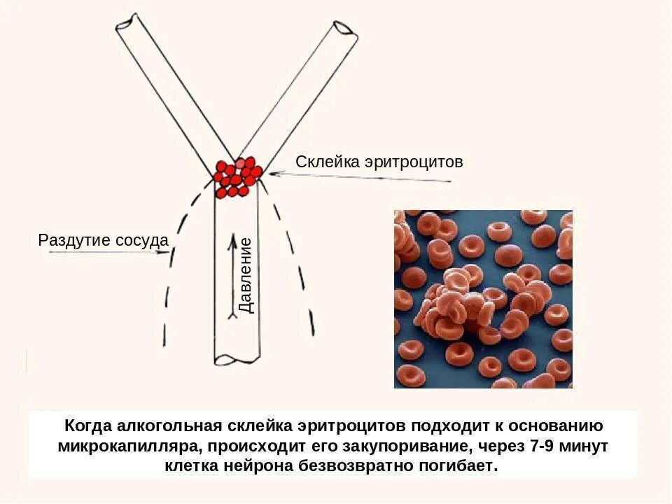 Склеивание крови. Закупорка сосуда склейкой эритроцитов. Алкогольная склейка эритроцитов.