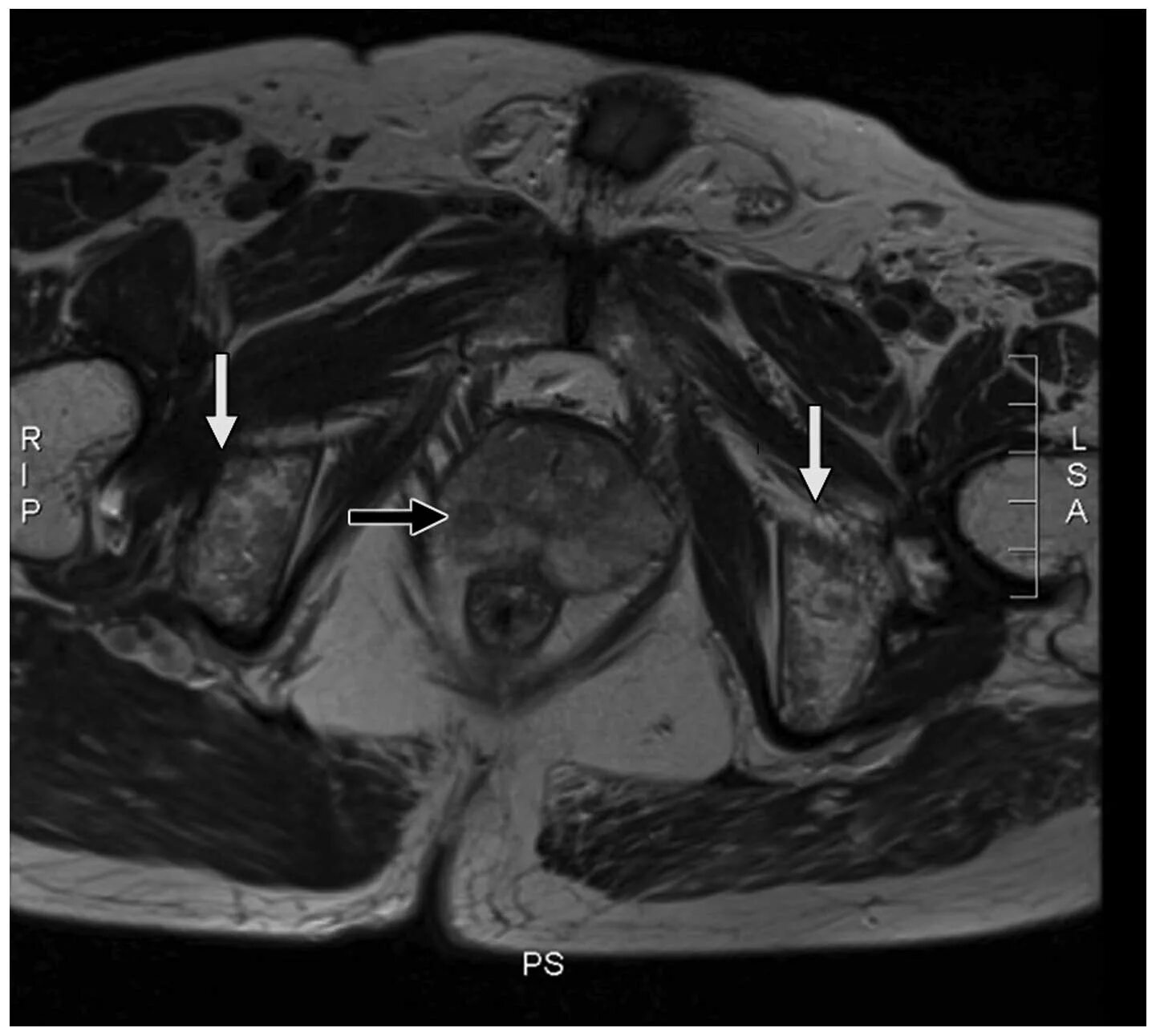 Предстательная железа капсула. Кальцинаты в t1 MRI.