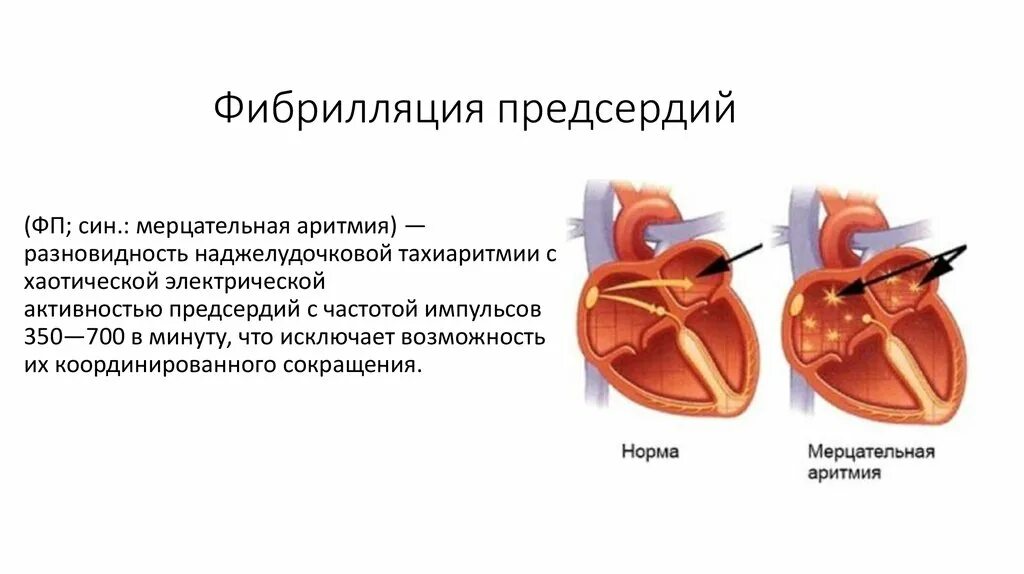 Мерцательная аритмия предсердий. Фибрилляция предсердий механизм развития. Фибрилляция предсердий патогенез кратко. Механизм возникновения фибрилляции предсердий. Предсердие болезни