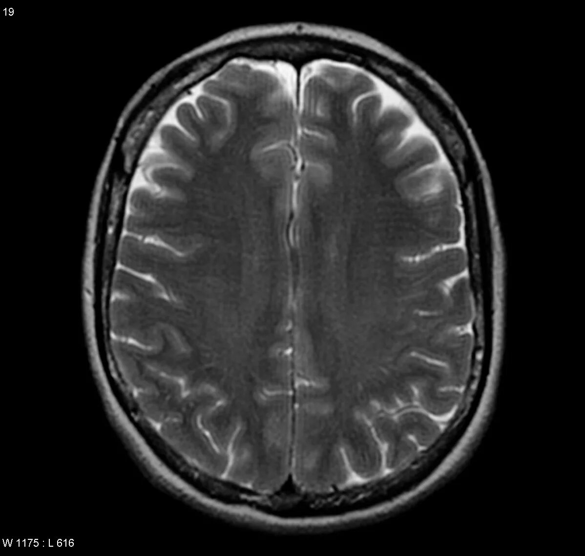 Глиобластома 4 степени. 5 См глиобластома головного мозга. Глиобластома головного мозга с очагами. Гигантская астроцитома в голове.