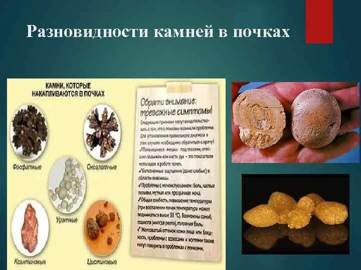 File:Kidney stones ( renal calculi ), Бубрежни камења 15.jpg - Wikimedia Commons