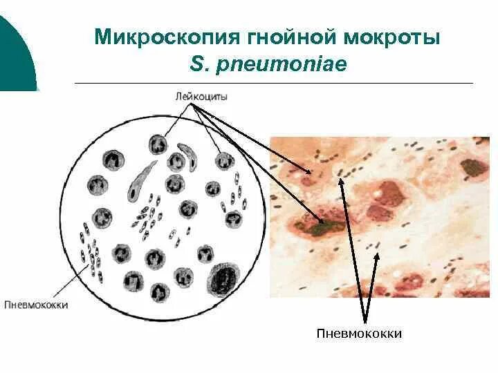 В мокроте можно обнаружить. Мокрота нативный препарат микроскопия. Микроскопия мокроты при пневмонии. Мерцательный эпителий в мокроте микроскопия. Микроскопия гнойной мокроты.