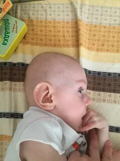 Симптомы микроцефалии у детей