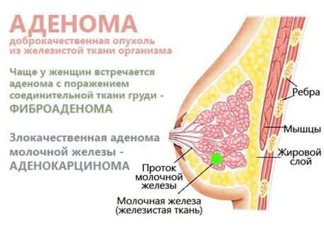Шишки в грудной железе