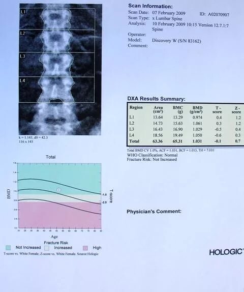 Денситометрия тазобедренных суставов и поясничного отдела позвоночника. Денситометрия костей расшифровка показателей. Денситометрия поясничного отдела остеопороз. Денситометрия поясничного отдела расшифровка. Показатели денситометрии поясничного отдела позвоночника.