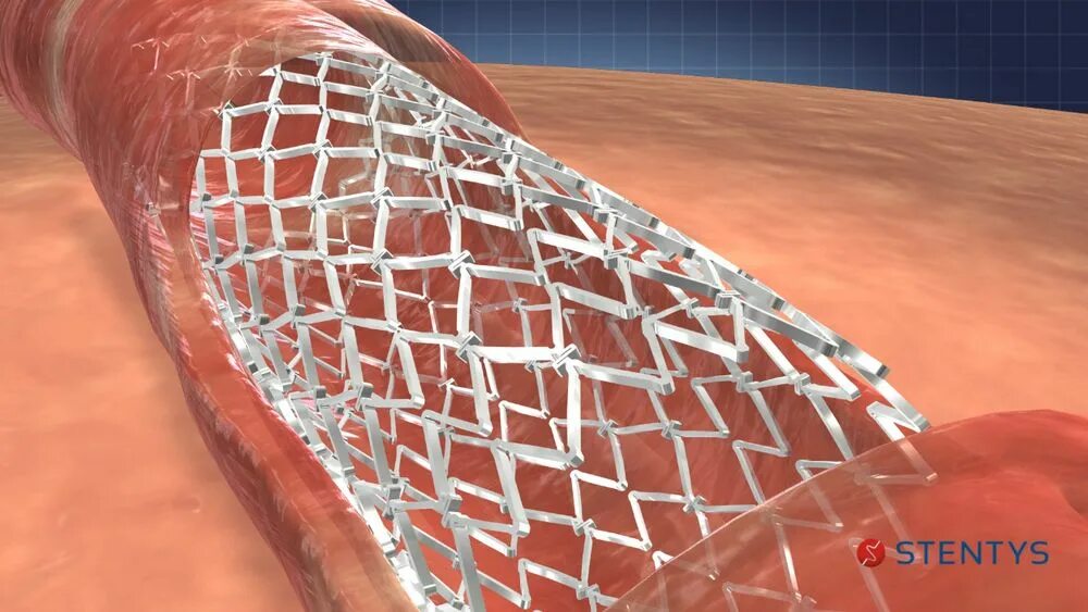 Стентирование видео. Коронарный стент Калипсо. Стенты Biomatrix. Калипсо стент покрытый. Сетчатый коронарный стент.