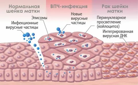 Папилломавирусная инфекция шейки