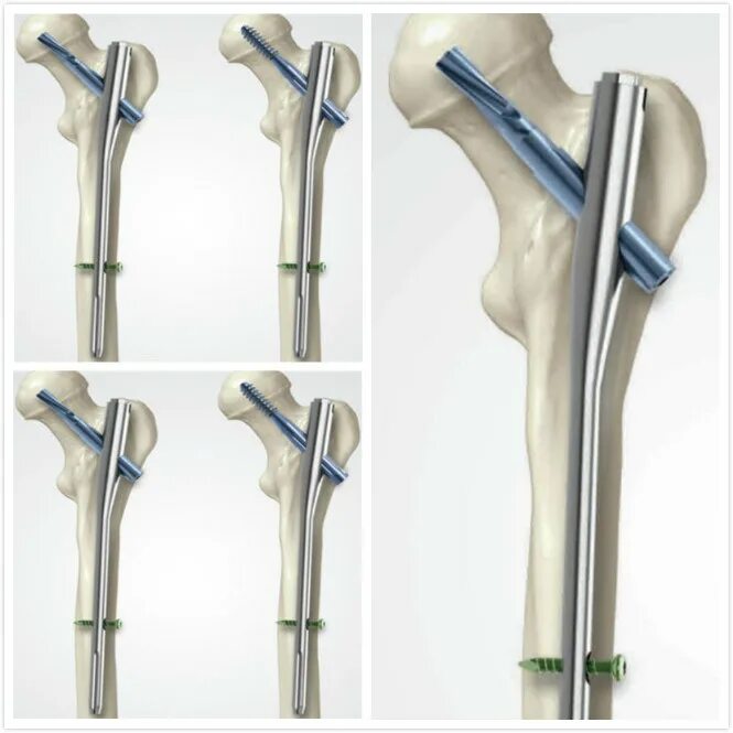 Гамма штифт. Штифт интрамедуллярный бедренный. Интрамедуллярный остеосинтез бедренной. Остеосинтез гамма стержнем. Long 135 citroen/peugeot 1613123580.