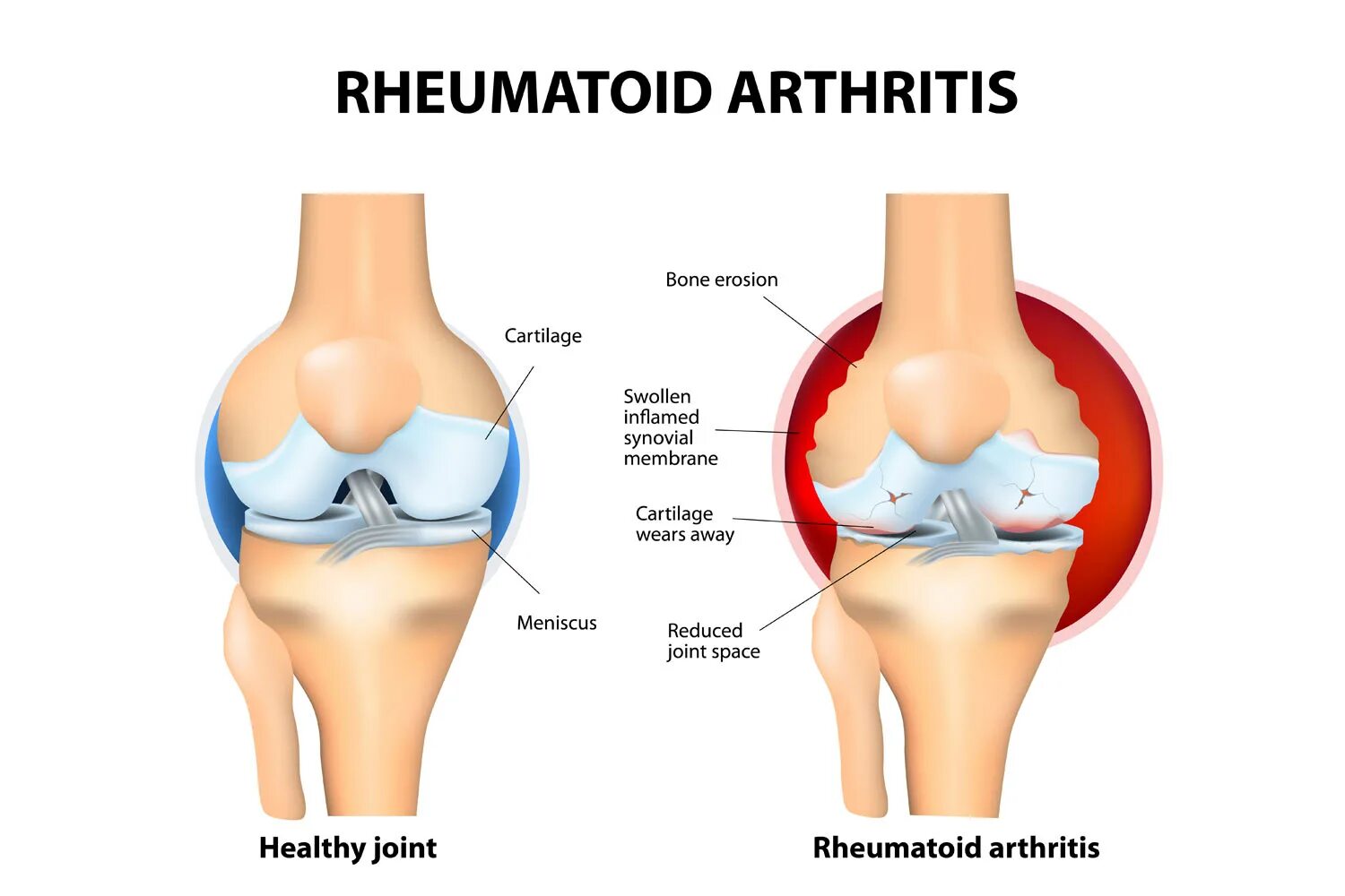 Артрит или артроз коленного сустава отличия. Артрит остеоартрит артроз. Ревматоидный артрит и артроз. Артрит коленного сустава схема. Артроз коленного сустава название