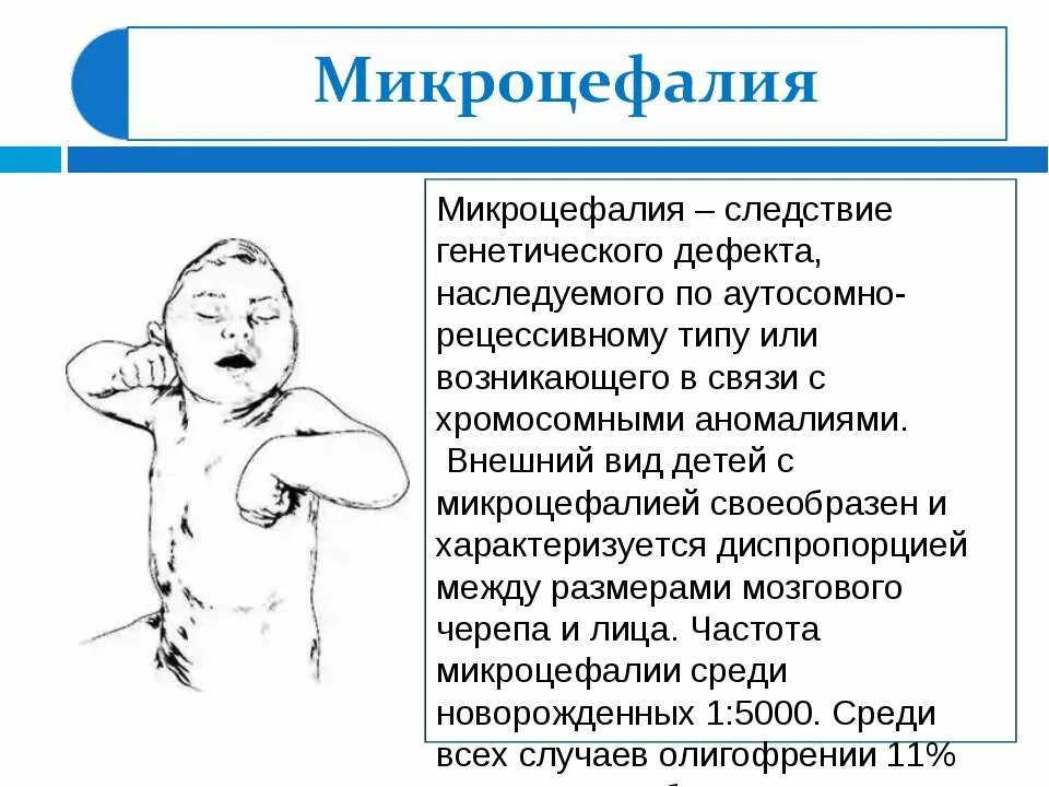 Микроцефалия причины. Микроцефалия головного мозга. Микроцефалия у новорожденных.