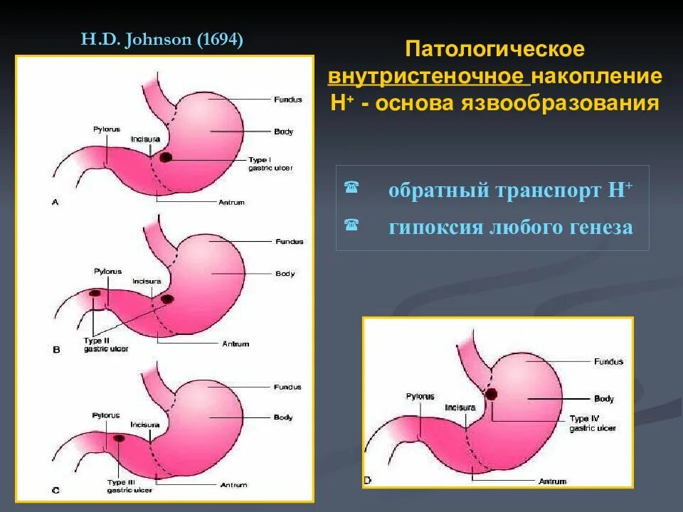 Хирургические заболевания желудка. Резекция желудка и двенадцатиперстной кишки. Резекция желудка при язвенной болезни. Резекция желудка язва желудка.