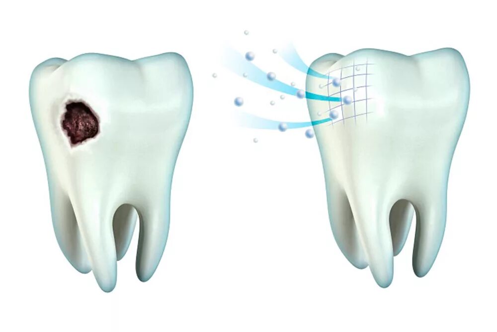 Фтор защита. Реминерализация эмали зубов. Реминерализация зубов кариес. Реминерализация (ремотерапия) зубов. Зуб c rfhbcjv.