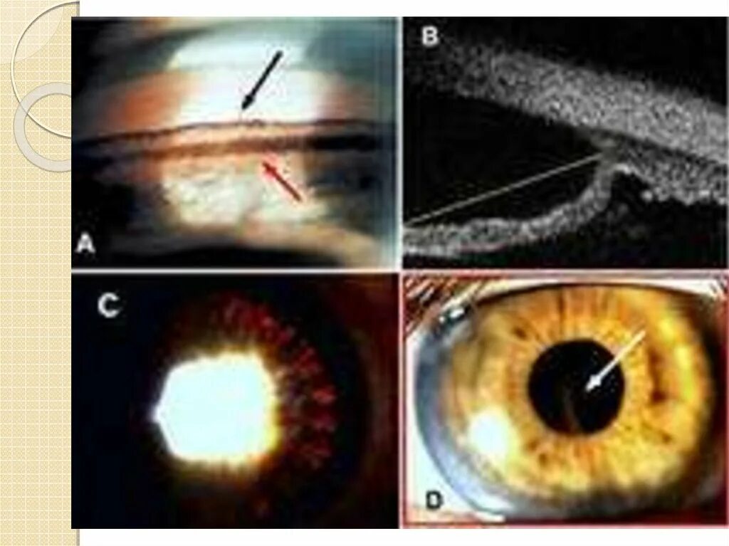 Пигментная открытоугольная глаукома. Неоваскулярная глаукома гониоскопия. Открытоугольная глаукома гониоскопия.