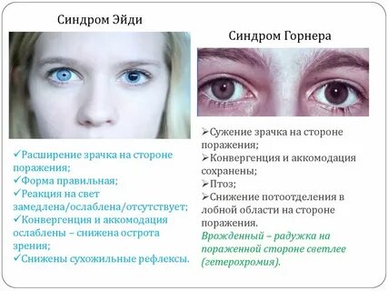 Почему глаза становятся разными