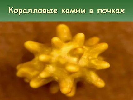 Коралловидный камень
