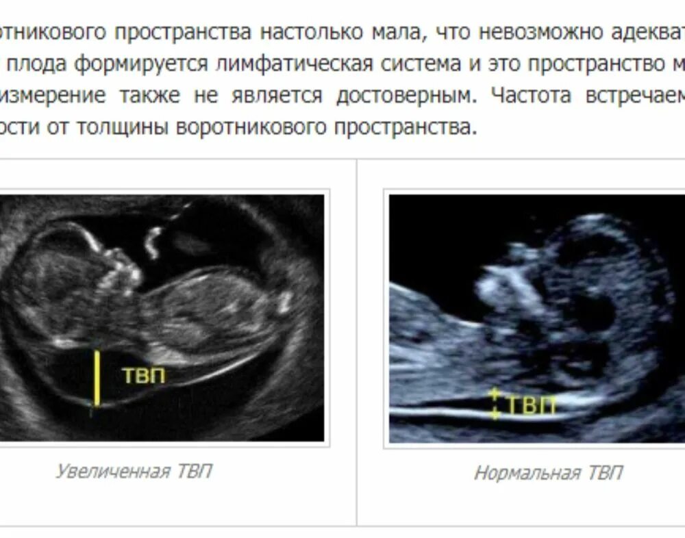 УЗИ плода толщина воротникового пространства. Норма ТВП У плода 12 недель УЗИ. Норма воротникового пространства в 12 недель беременности. ТВП плода норма в 13 недель беременности.