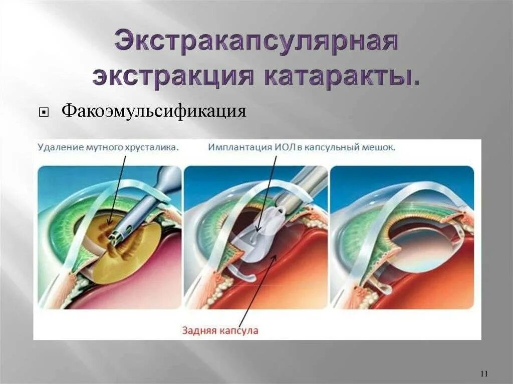 Экстракция увеальной катаракты. Факоэмульсификация (экстракапсулярная экстракция. Катаракта экстракапсулярная экстракция. Ультразвуковое хирургия катаракты - факоэмульсификация.