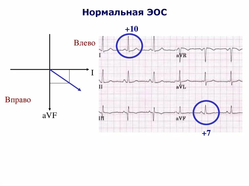 Отклонение ЭОС влево на ЭКГ. Нормальная ЭОС. ЭОС влево вправо. Нормальная электрическая ось. Сердце отклонено вправо