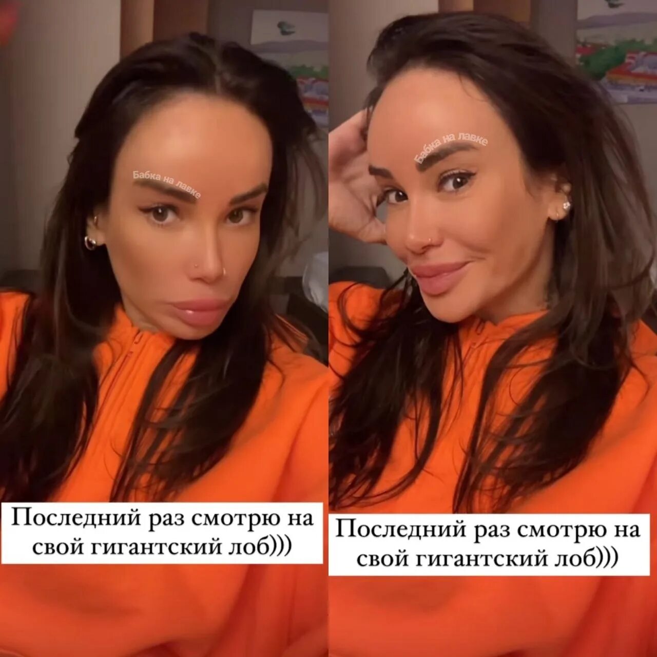 Айза пересадка волос до и после Айза сделала операцию по пересадке волос Вокруг ТВ.