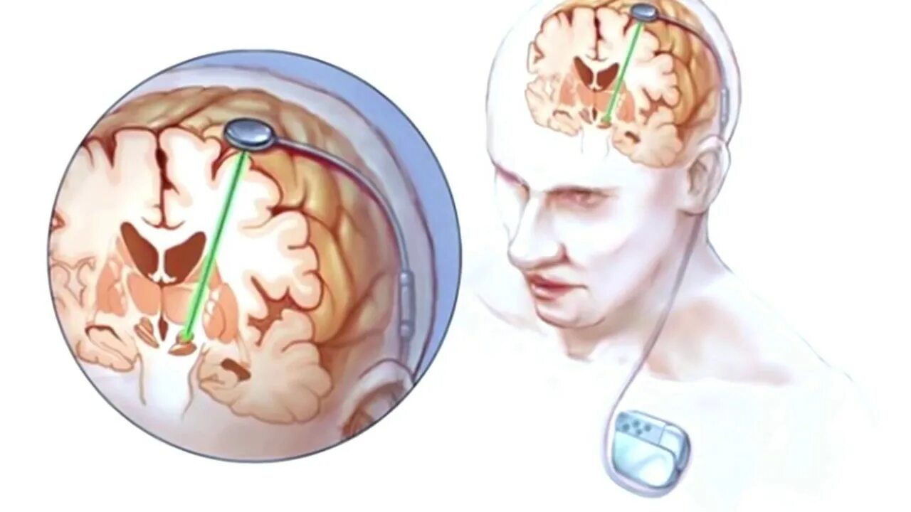 Операция при эпилепсии. Глубокая стимуляция мозга при болезни Паркинсона. Глубокая стимуляция мозга DBS. Нейростимулятор при болезни Паркинсона. Электроды в головной мозг.
