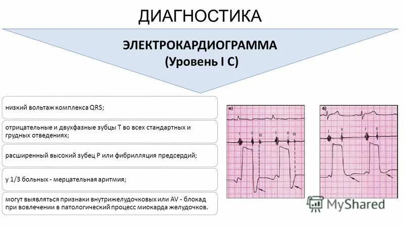 Узловая экстрасистолия на экг. Продолжительность комплекса qrs на экг в норме составляет. Экг типы комплексов qrs. Отрицательный зубец р после qrs комплекса. Отрицательный зубец r в avf.