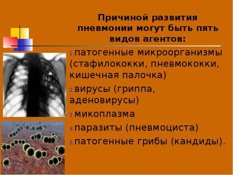 Чем лечить микоплазму пневмонию