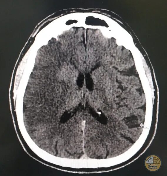 Тромбоз синусов головного мозга кт. Ишемия на кт. Ишемия мозга на кт. Тромбоз на кт