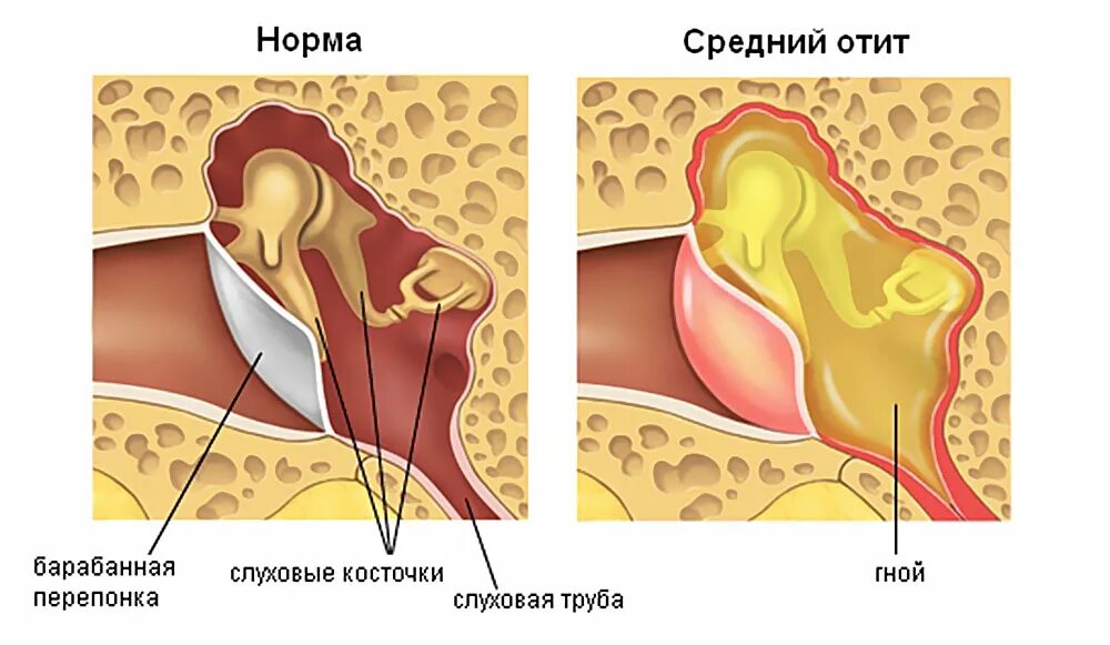 Сколько лечить отит. Сколько лечить отит