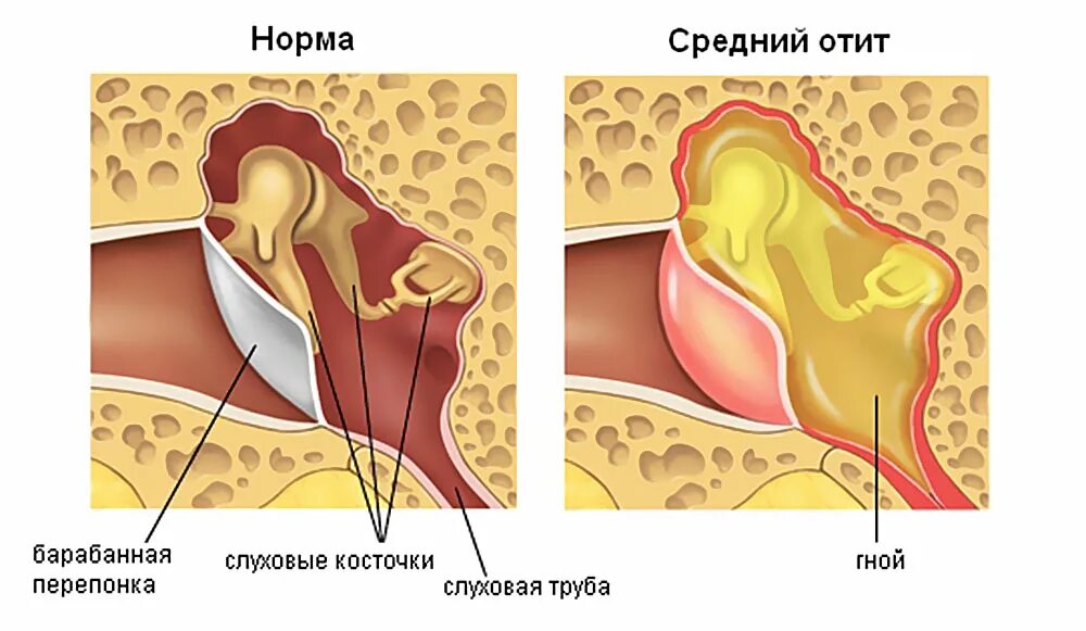 Гнойный отит барабанная перепонка. Острый Гнойный средний отит барабанная перепонка. Туботимпанальный Гнойный отит. Парацентез барабанной перепонки это