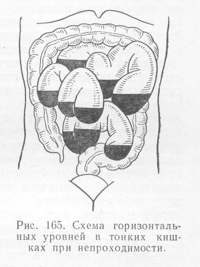 Симптом чаши. Острая кишечная непроходимость рентген схема. острая кишечная непроходимость спастическая. кишечная непроходимость чаши клойбера. кишечная непроходимость симптомы рентген.