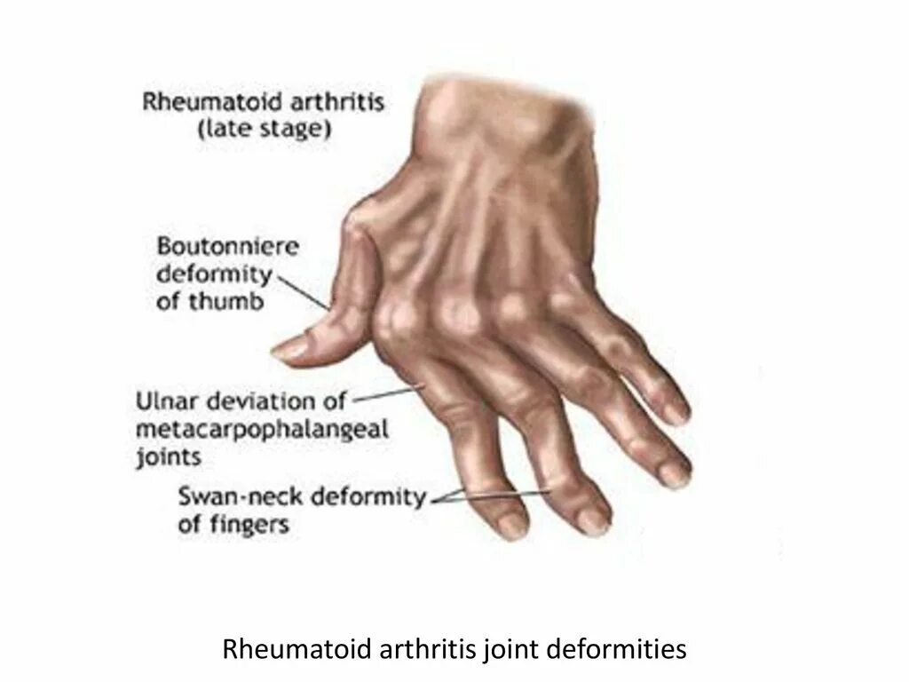 Скованность при ревматоидном артрите. Клиническая картина ревматоидного артрита кратко. Ревматоидный артрит клиника. Ревматоидный артрит клинические симптомы. Основные клинические проявления ревматоидного артрита.