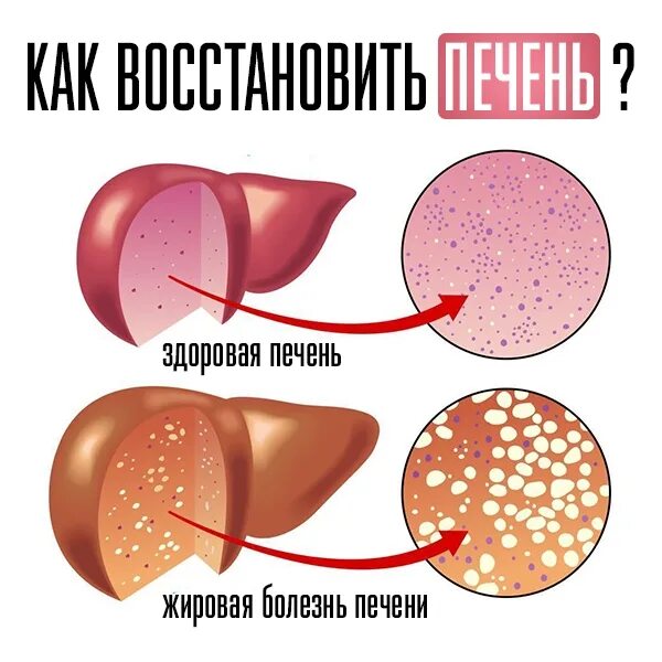 Как восстановить печень после длительного приема лекарств. Восстановление печени. восстанавливающий печень. печень может восстановиться.