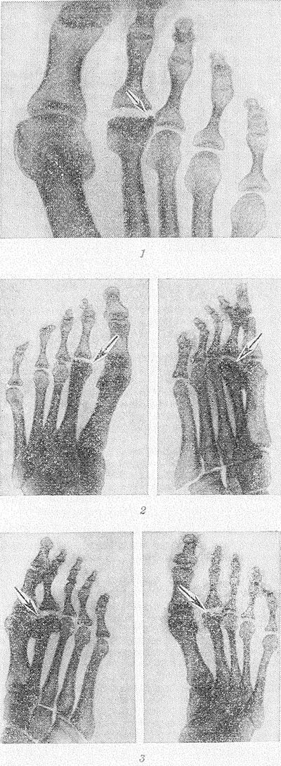 Остеохондропатия головки 2 плюсневой кости. Остеохондропатия головки 1 плюсневой кости. Остеохондропатия 2 плюсневой кости стопы.