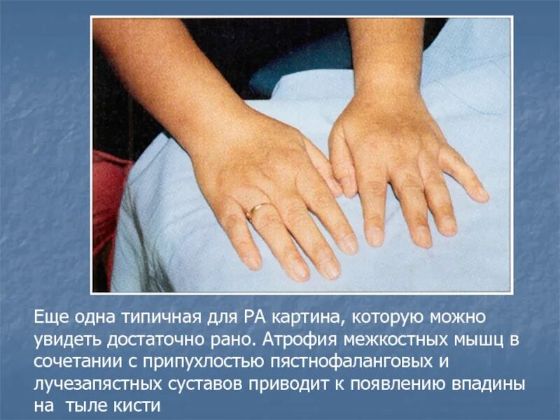 Атрофия кисти руки. Атрофия мышц тенара и гипотенара. Атрофия кисти руки. Кисть при нейропатии локтевого нерва. Атрофия мышцы возвышения большого пальца.