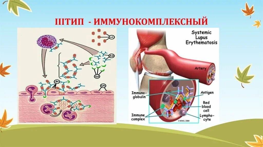 Иммунокомплексный тип реакции. Иммунокомплексный тип аллергической реакции механизм. иммунокомплексный тип аллергической реакции схема. аллергическая реакция иммунокомплексного типа. иммунокомплексная реакция (iii тип).