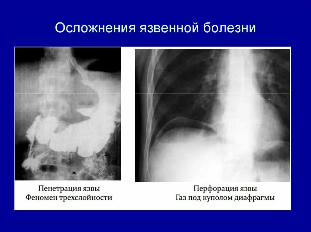 Рентген пенетрирующая язва ДПК. Перфоративная язва желудка осложненная. Перфорация язвы желудка рентген схема. Перфорация гастродуоденальной язвы на рентгене.