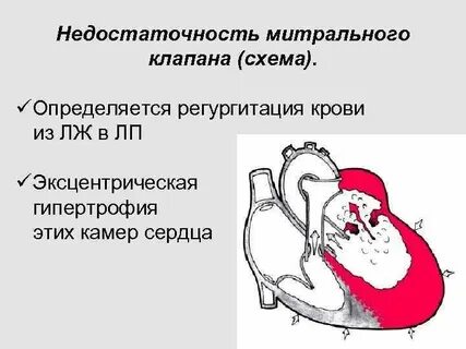 Недостаточность митрального клапана гемодинамика