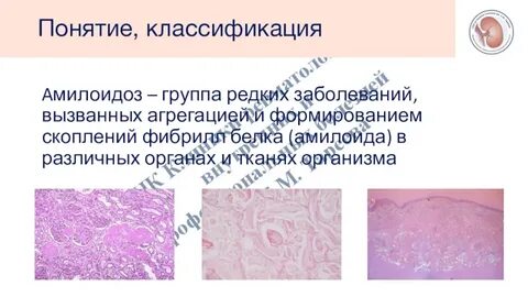 Амилоидоз прогноз