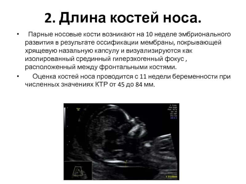 Носовая кость визуализируется 2.1 мм. УЗИ 12 недель беременности носовая кость норма. Норма костей носа у плода в 13 недель. Носовая кость 3,3мм. Кости в 13 недель