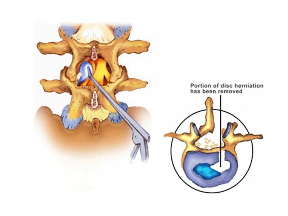 Операция межпозвоночной грыжи микродискэктомия. Микродискэктомия грыжи позвоночника. Эндоскопическая дискэктомия грыжи позвоночника. Микродискэктомия грыжи позвоночника поясничного отдела. Лечение позвоночной грыжи операция