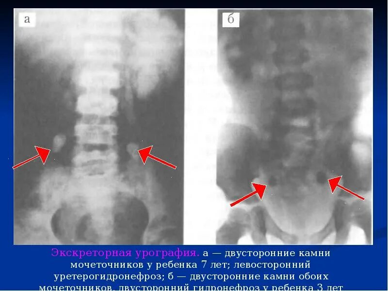 Мочекаменная болезнь мочеточника. Обзорная урограмма мочекаменная болезнь. Мочекаменная болезнь экскреторная урография. Экскреторная урография гидронефроз снимки. Экскреторная урография почек рентген.