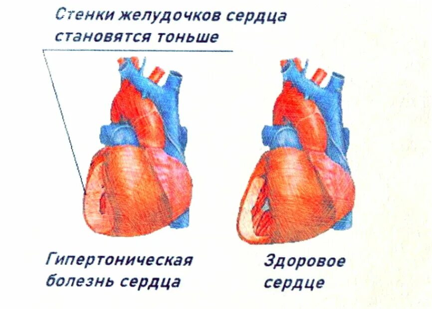 Сердцем отличай. Гипертоническая болезнь. Гипертрофическая болезнь. Нипертоническа ЯБОЛЕЗНЬ. Заболевания сердца гипертония.