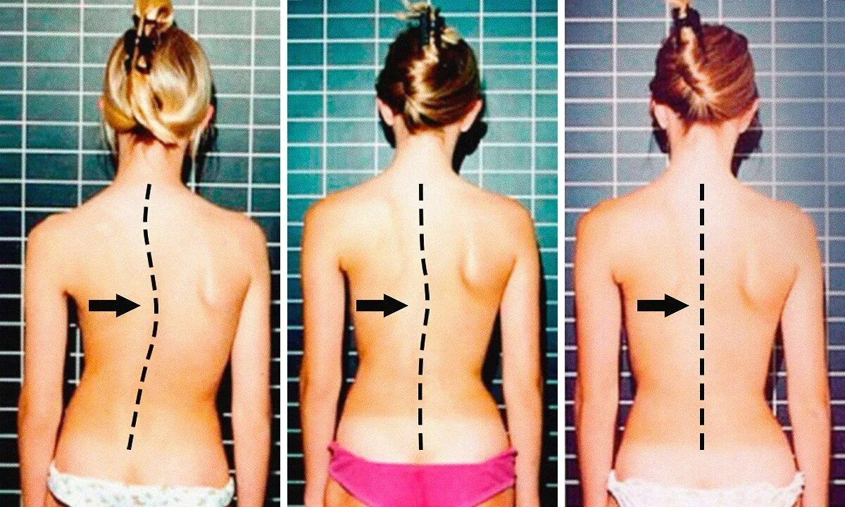 Боль в пояснице. Искривление позвоночника сколиоз. Деформации позвоночника ( сколиоз, лордоз, гиперкифоз). Искривление позвоночника сколиоз и кифоз. Как понять что со спиной.