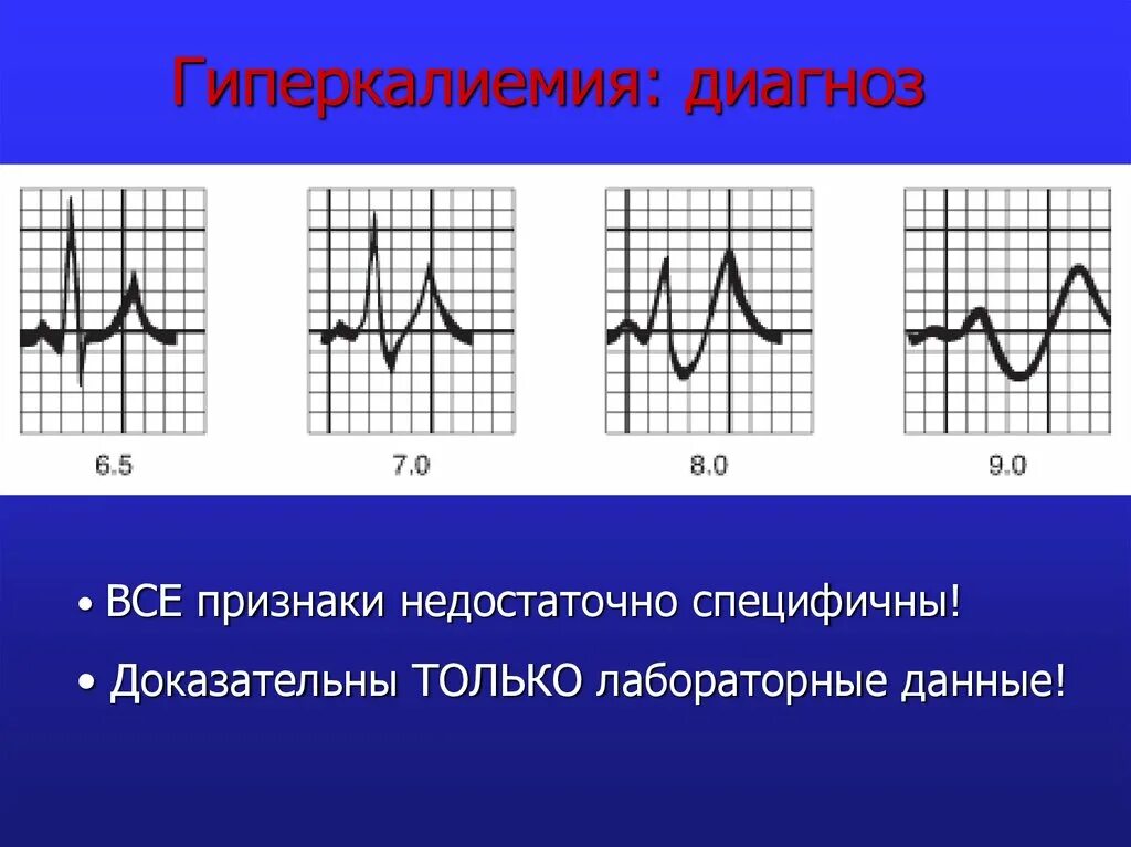 Гиперкалиемия что. ЭКГ при гипокалиемии и гиперкалиемии. Гиперкалиемия на ЭКГ. Диагноз гиперкалиемия. Гиперкалиемия на ЭКГ признаки.