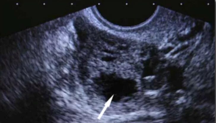 Боль в яичниках на ранних сроках беременности. Персистенция фолликула на УЗИ. Жёлтое тело в яичнике на УЗИ.