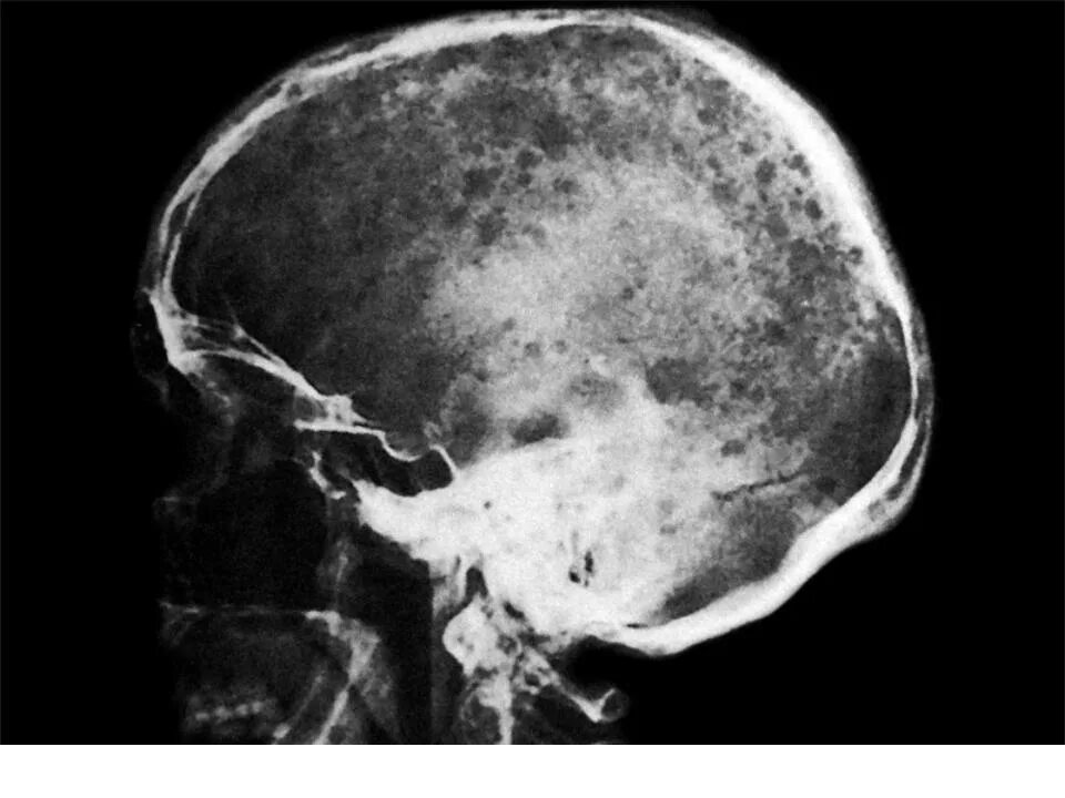 Очаговые изменения костей. Миеломная болезнь рентген черепа. Миеломная болезнь на кт черепа. Миеломная болезнь костей черепа на кт. Миеломная болезнь рентген.